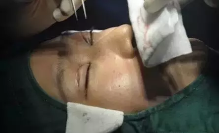 做埋线双眼皮手术恢复时间大概要多久 割埋线双眼皮手术恢复过程真人案例果照片图