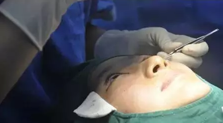 做埋线双眼皮手术恢复时间大概要多久 割埋线双眼皮手术恢复过程真人案例果照片图