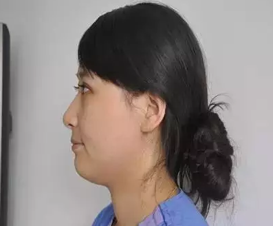 做埋线双眼皮手术恢复时间大概要多久 割埋线双眼皮手术恢复过程真人案例果照片图