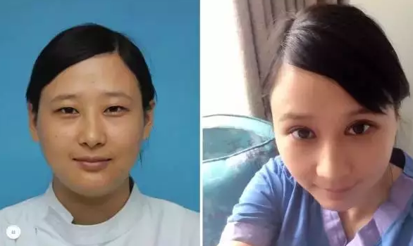 做埋线双眼皮手术恢复时间大概要多久 割埋线双眼皮手术恢复过程真人案例果照片图