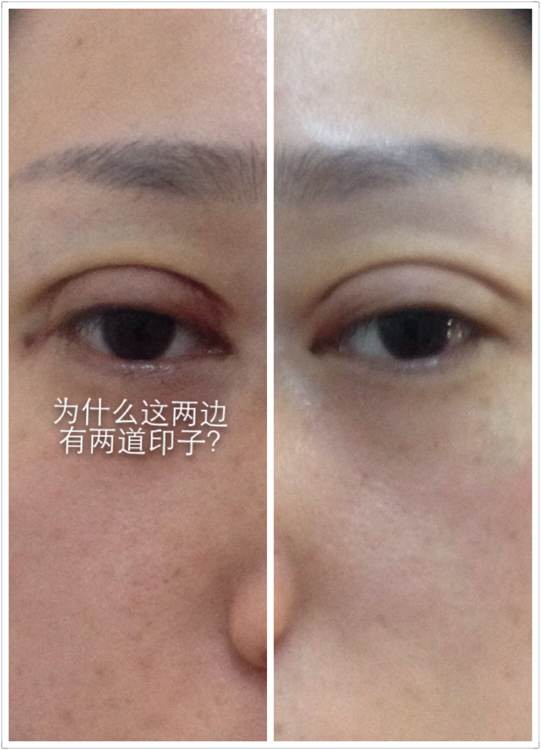 韩式六点定位双眼皮手术和微创定点定位双眼皮手术有什么区别