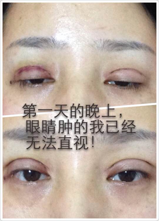 韩式六点定位双眼皮手术和微创定点定位双眼皮手术有什么区别