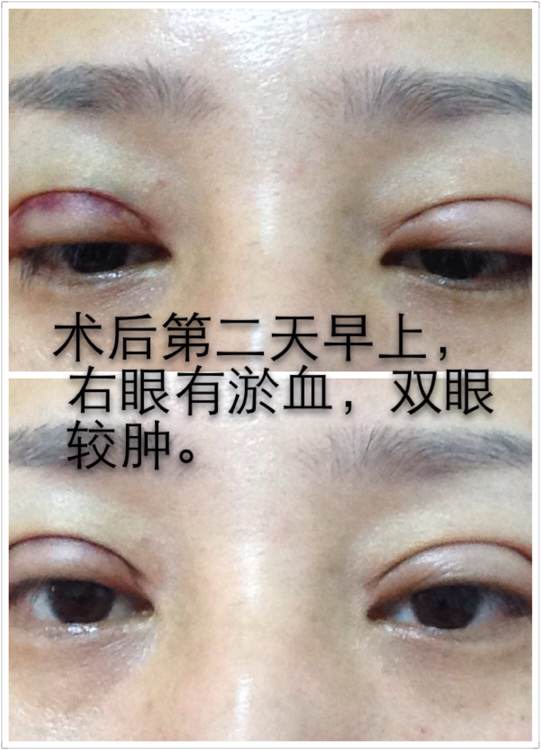 韩式六点定位双眼皮手术和微创定点定位双眼皮手术有什么区别