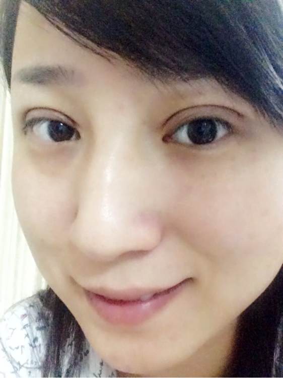 韩式六点定位双眼皮手术和微创定点定位双眼皮手术有什么区别