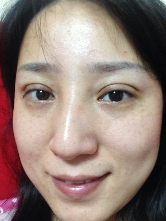 韩式六点定位双眼皮手术和微创定点定位双眼皮手术有什么区别