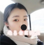 割双眼皮手术前后对比真人果照片案例图 微创定点定位双眼皮手术全过程