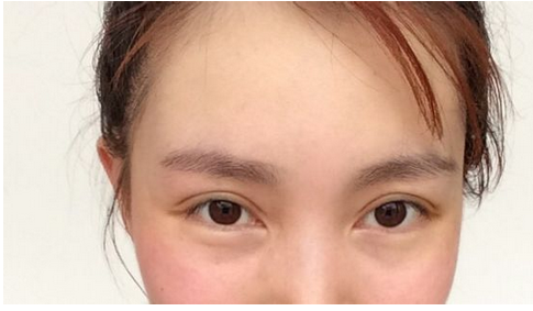 割双眼皮手术前后对比真人果照片案例图 微创定点定位双眼皮手术全过程