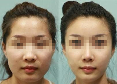 头y线额头窄怎么办 头y线额头窄有什么妙招