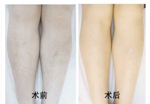 Z适合激光脱毛的季节是什么 激光脱毛果对比图