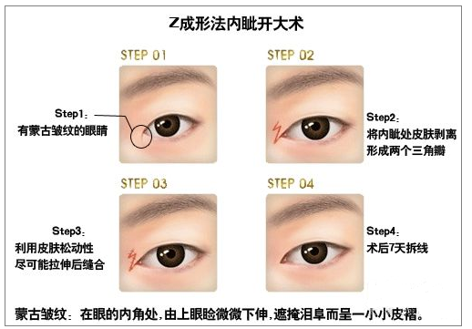 开眼角手术费用多少钱 开眼角前后对比照片图