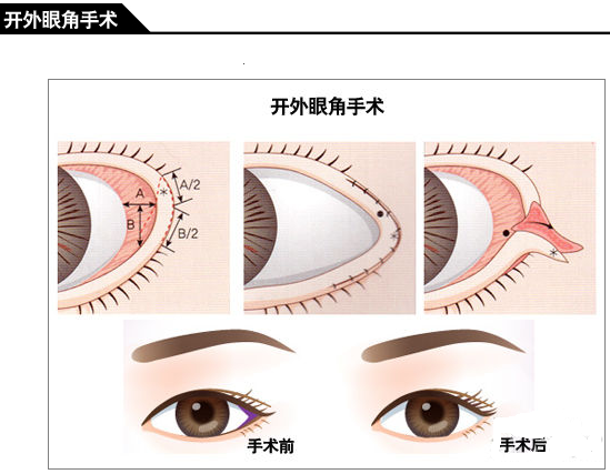 开眼角手术费用多少钱 开眼角前后对比照片图