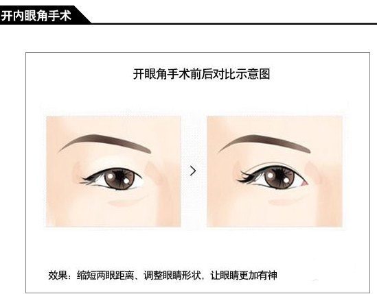 开眼角手术费用多少钱 开眼角前后对比照片图