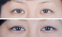 开眼角手术费用多少钱 开眼角前后对比照片图 开眼角手术费用多少钱 开眼角前后对比照片图