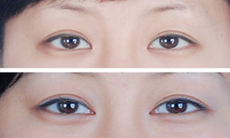 开眼角手术费用多少钱 开眼角前后对比照片图