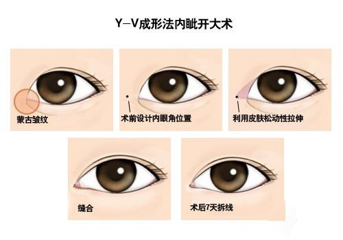 开眼角手术费用多少钱 开眼角前后对比照片图