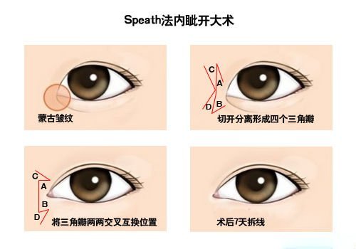 开眼角手术费用多少钱 开眼角前后对比照片图