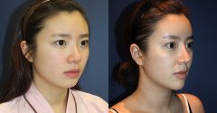 垫高鼻子要多少钱 垫高鼻子的几个误区 垫高鼻子要多少钱 垫高鼻子的几个误区