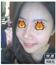 下颌角截骨术怎么样 下颌角截骨术案例分享