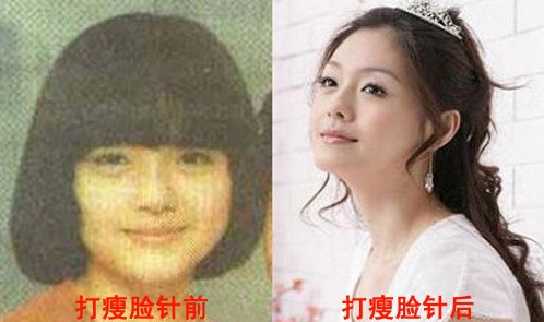 【B****前后对比图】揭秘娱乐圈女星打B****前后对比图