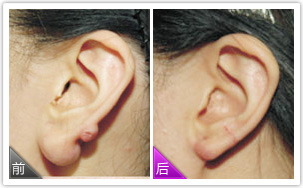 注射玻尿酸丰耳垂果怎么样 注射玻尿酸丰耳垂前后对比图