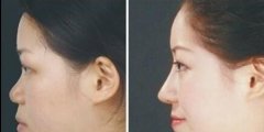 玻尿酸隆鼻能保持多久 玻尿酸隆鼻多少钱