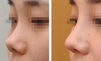 硅胶隆鼻的优点、硅胶隆鼻有什么好处