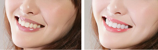 烤瓷牙的寿命是多久 烤瓷牙崩瓷了怎么办