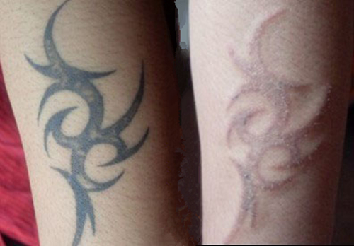 洗纹身要多少钱洗纹身前后对比图