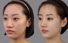 假体隆鼻怎么样、假体隆鼻什么材料好