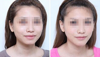 隆下颌的成好吗 隆下颌手术前后对比照片