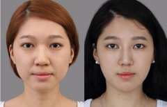 假体隆鼻后果自然吗、假体隆鼻能保持多久