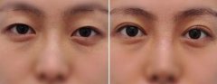 双眼皮好吗 双眼皮是永.久的吗