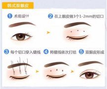 双眼皮手术方法有几种?如何选择适合自己的? 双眼皮手术方法有几种?如何选择适合自己的?