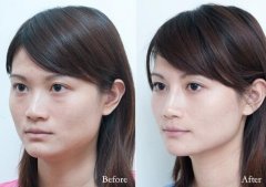 玻尿酸隆鼻怎么样、玻尿酸隆鼻有副作用吗