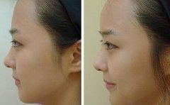 玻尿酸隆鼻 玻尿酸隆鼻的副作用