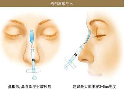 点击查看源网页 假体隆鼻和注射隆鼻果哪个比较好?