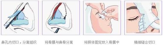 点击查看源网页 假体隆鼻和注射隆鼻果哪个比较好?