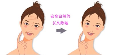 生物除皱的价格多少钱 生物除皱前后果对比图