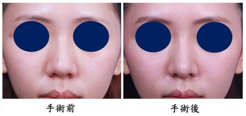 鼻头缩小术多少钱 鼻头缩小术果怎么样