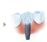 微创种植牙的手术过程介绍