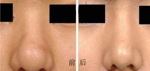 鼻头缩小术多少钱 鼻头缩小术果怎么样