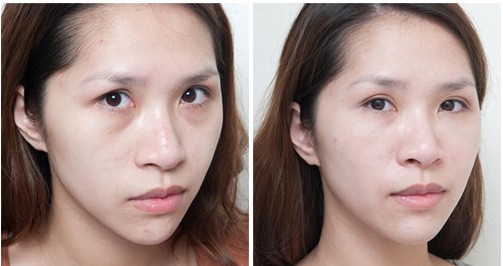 脸上出现泪沟纹怎么办泪沟纹该怎么去除