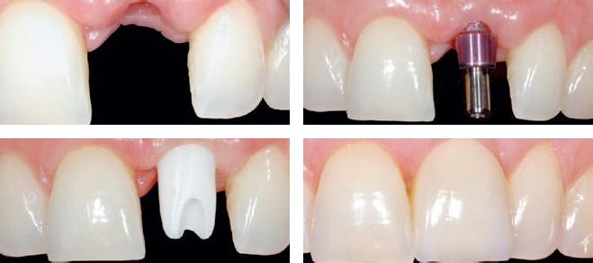 微创种植牙的手术过程介绍