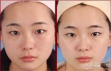 激光祛斑有副作用吗 激光祛斑有疤痕吗