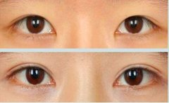 双眼皮有哪些优点 双眼皮缺点是什么