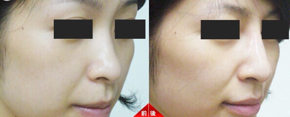 微j瓷隆鼻价格多少钱 微j瓷隆鼻可靠性高吗