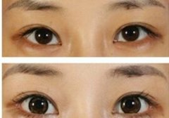 开眼角术后注意事项 开眼角术后护理 开眼角术后注意事项 开眼角术后护理