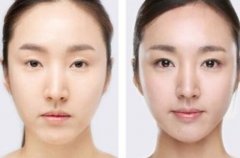 开眼角前后对比 开眼角前后对比图 开眼角前后对比 开眼角前后对比图