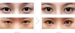 开眼角要恢复多久 开眼角可以保持多久 开眼角要恢复多久 开眼角可以保持多久