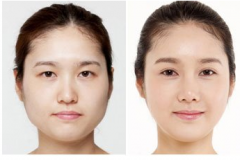 生物焊接双眼皮价格多少钱 生物焊接双眼皮前后对比图